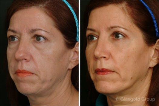 Fat Transfer Before & After Gallery - Patient 104515 - Image 3