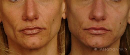 Jawline Lower Face Rejuvenation Before & After Gallery - Patient 154254 - Image 2