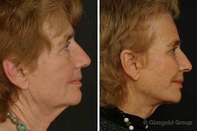 Facelift Before & After Gallery - Patient 198185 - Image 1