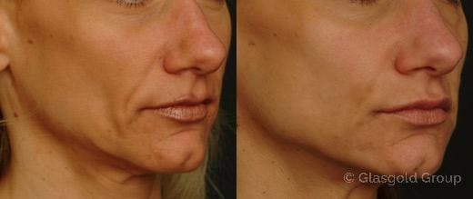 Jawline Lower Face Rejuvenation Before & After Gallery - Patient 154254 - Image 1