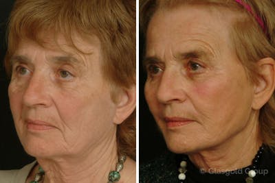 Facelift Before & After Gallery - Patient 198185 - Image 1