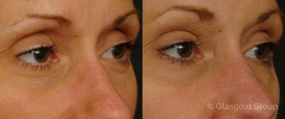 Upper Eyelid Rejuvenation Before & After Gallery - Patient 821618 - Image 1