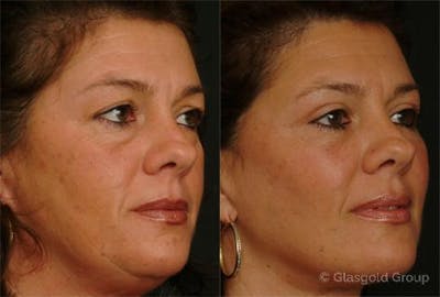 Fat Transfer Before & After Gallery - Patient 375035 - Image 1