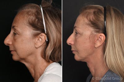 Facelift Before & After Gallery - Patient 321781 - Image 1