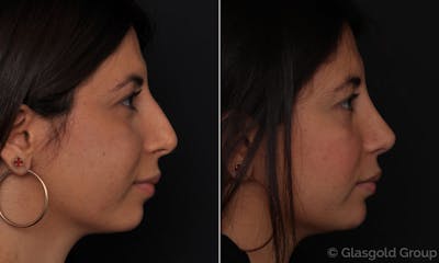 Rhinoplasty Before & After Gallery - Patient 104649 - Image 1