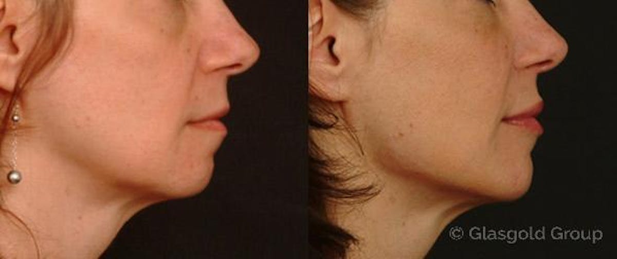 Jawline Lower Face Rejuvenation Before & After Gallery - Patient 404084 - Image 1