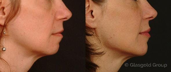 Jawline Lower Face Rejuvenation Before & After Gallery - Patient 404084 - Image 1