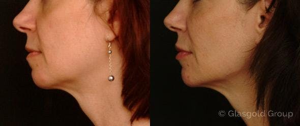 Jawline Lower Face Rejuvenation Before & After Gallery - Patient 404084 - Image 2