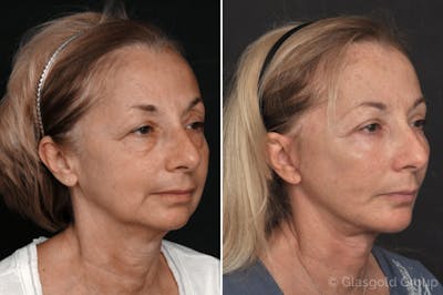 Facelift Before & After Gallery - Patient 321781 - Image 1