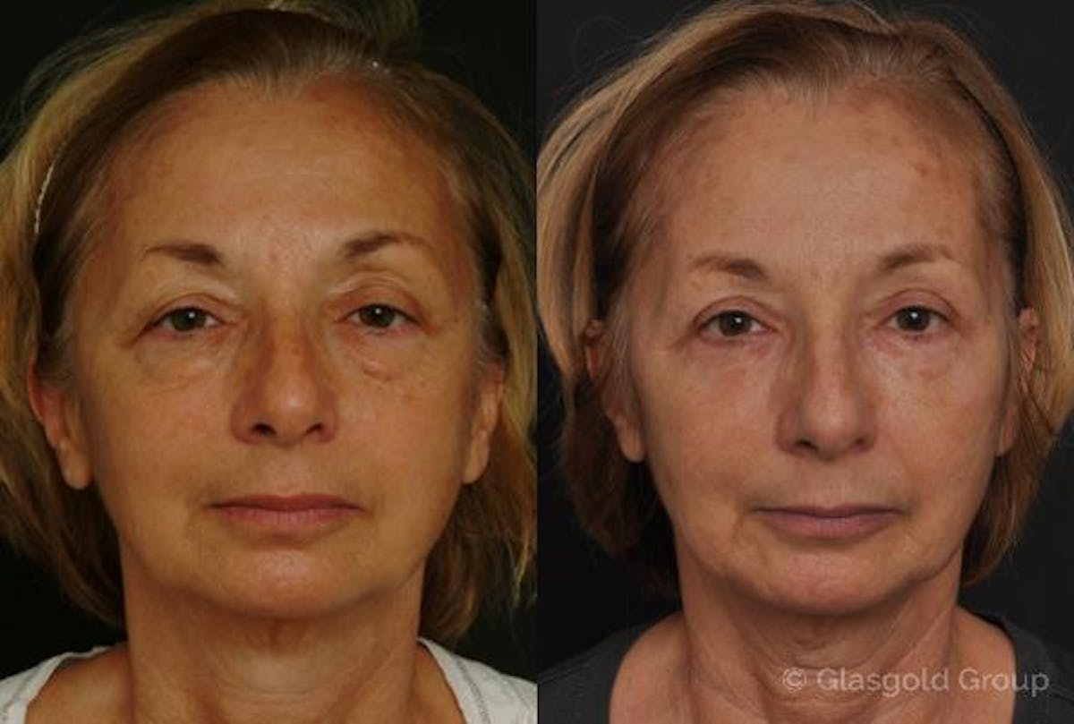 Fat Transfer Before & After Gallery - Patient 405772 - Image 2
