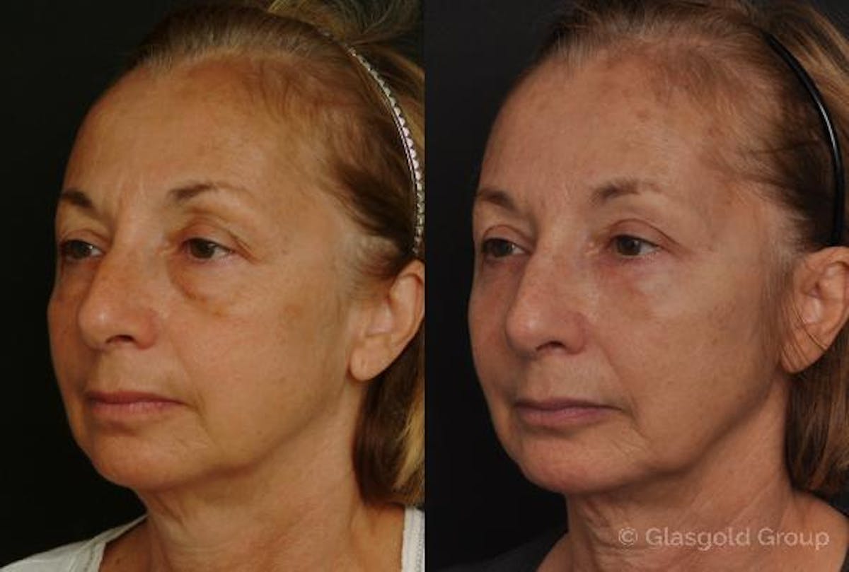 Fat Transfer Before & After Gallery - Patient 405772 - Image 3