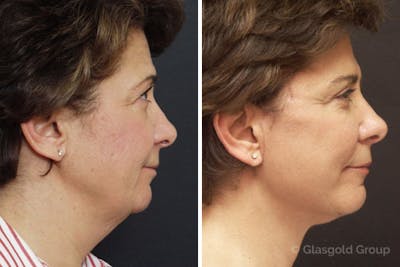 Facelift Before & After Gallery - Patient 316427 - Image 1