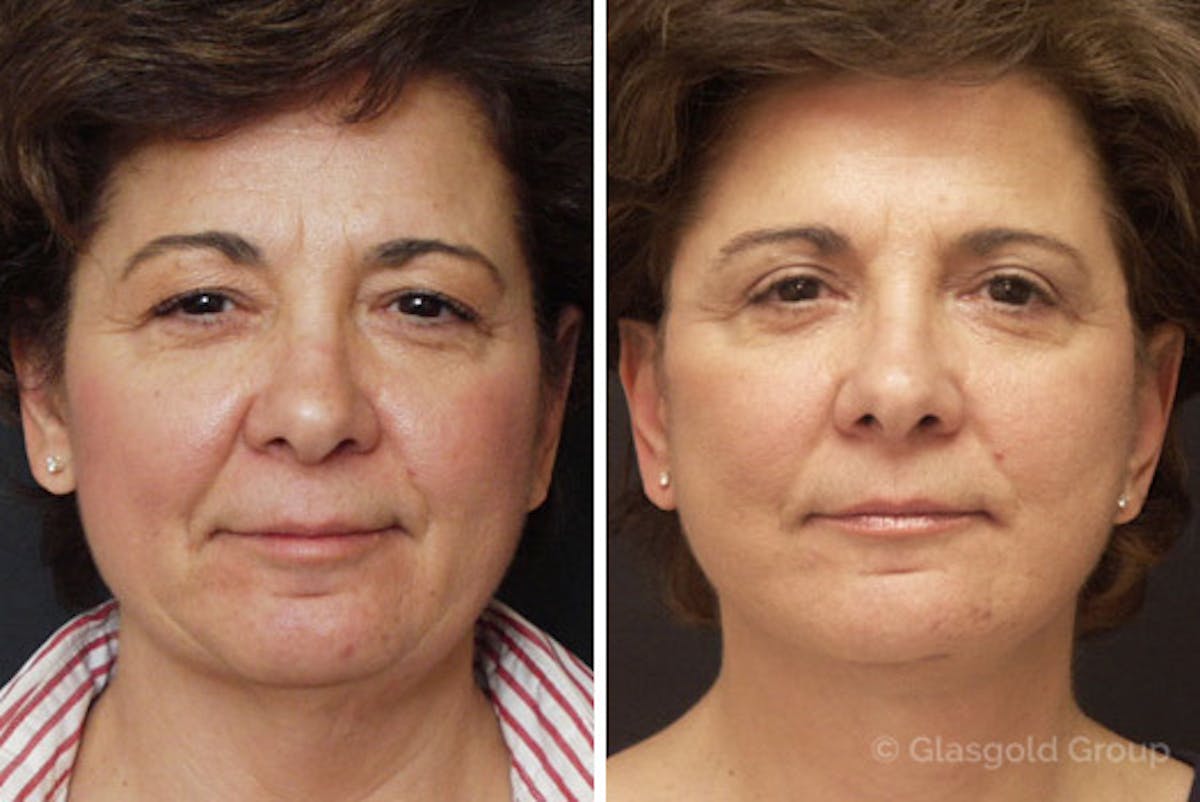 Facelift Before & After Gallery - Patient 316427 - Image 3