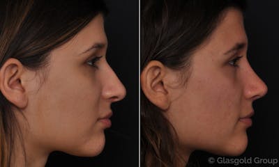Rhinoplasty Before & After Gallery - Patient 102670 - Image 1