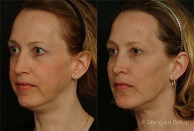 Fat Transfer Before & After Gallery - Patient 117682 - Image 1