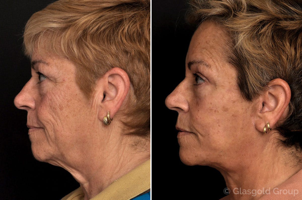 Facelift Before & After Gallery - Patient 309081 - Image 2