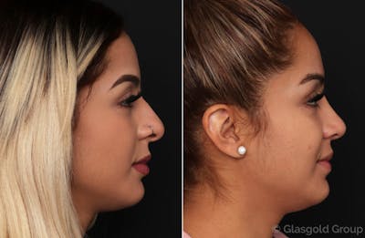 Rhinoplasty Before & After Gallery - Patient 479888 - Image 1