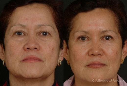 Fat Transfer Before & After Gallery - Patient 781220 - Image 2
