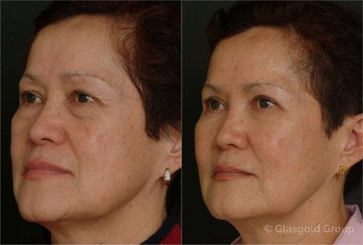 Fat Transfer Before & After Gallery - Patient 781220 - Image 3