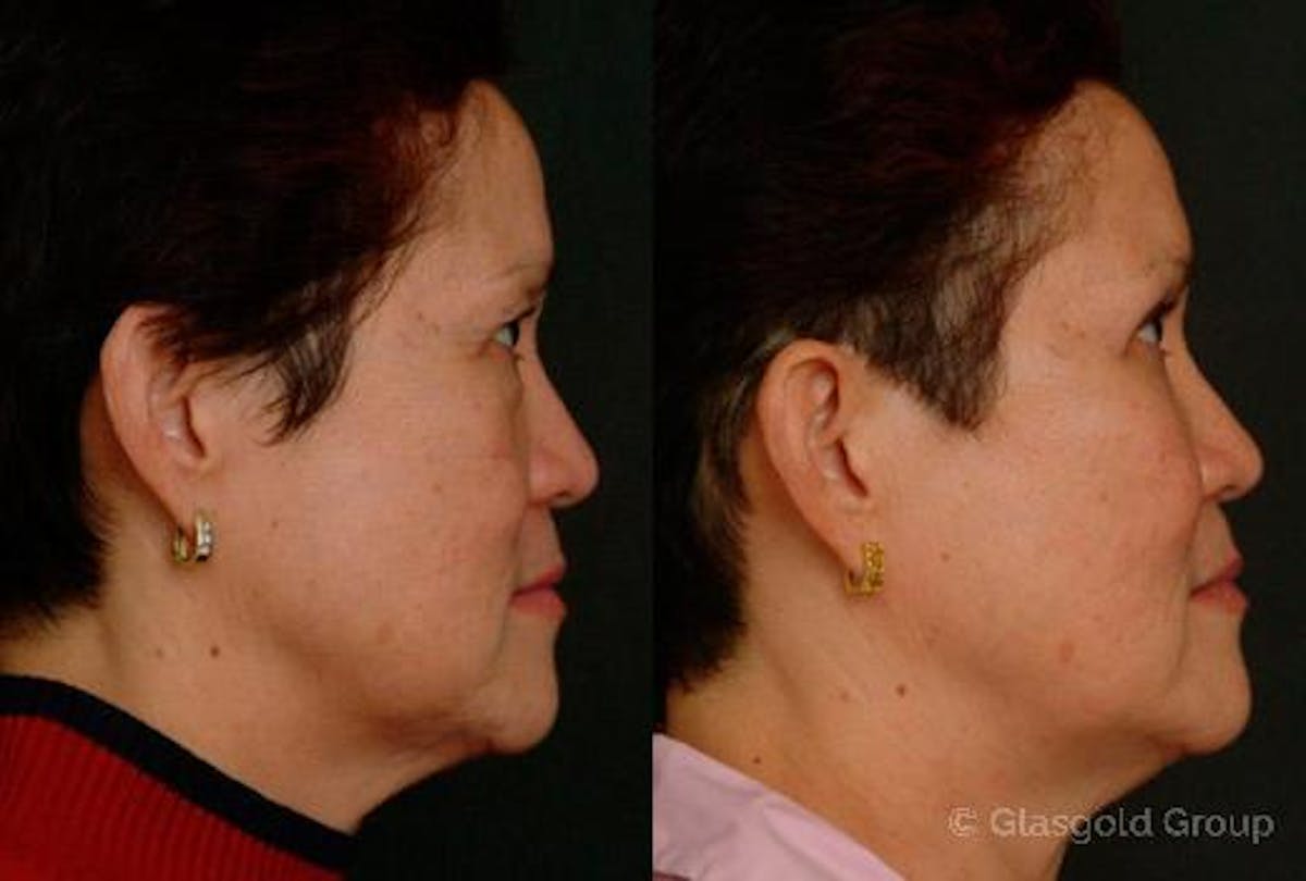 Fat Transfer Before & After Gallery - Patient 781220 - Image 1
