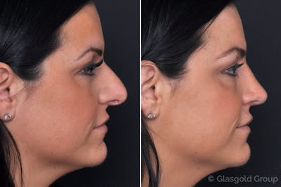 Rhinoplasty Before & After Gallery - Patient 325520 - Image 1