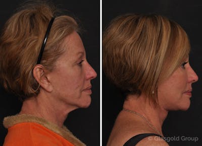 Facelift Before & After Gallery - Patient 115550 - Image 1