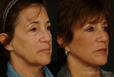 Fat Transfer Before & After Gallery - Patient 305163 - Image 1