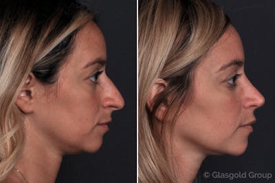 Rhinoplasty Before & After Gallery - Patient 409452 - Image 1
