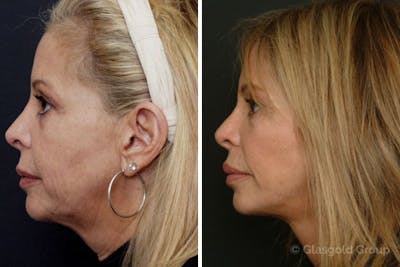 Facelift Before & After Gallery - Patient 236763 - Image 1