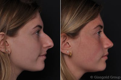 Rhinoplasty Before & After Gallery - Patient 795555 - Image 1