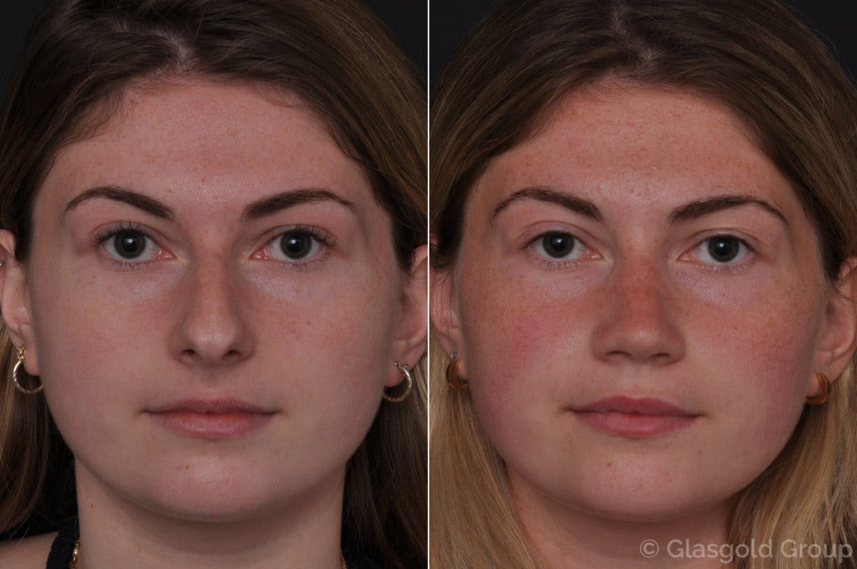 Rhinoplasty Before & After Gallery - Patient 795555 - Image 2