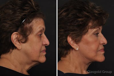 Facelift Before & After Gallery - Patient 420100 - Image 1