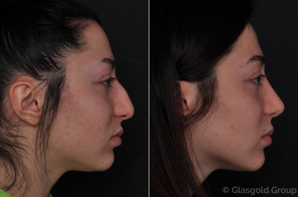 Rhinoplasty Before & After Gallery - Patient 237655 - Image 1