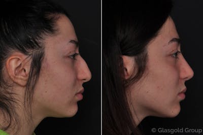Rhinoplasty Before & After Gallery - Patient 237655 - Image 1
