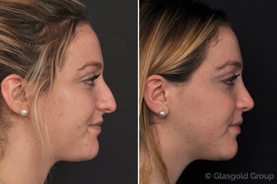 Rhinoplasty Before & After Gallery - Patient 295680 - Image 1