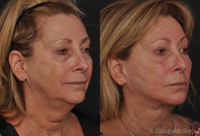 Facelift Before & After Gallery - Patient 124468 - Image 1