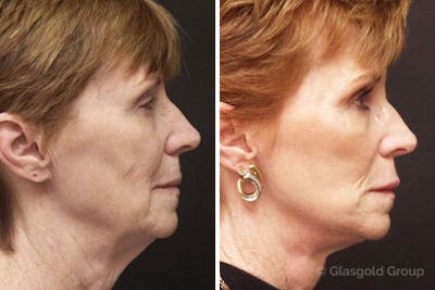 Facelift Before & After Gallery - Patient 725624 - Image 1