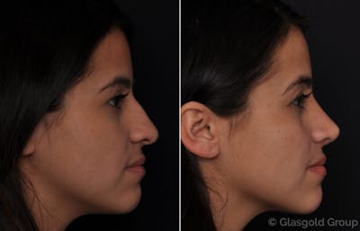 Rhinoplasty Before & After Gallery - Patient 319048 - Image 1