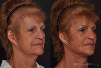 Fat Transfer Before & After Gallery - Patient 743504 - Image 1