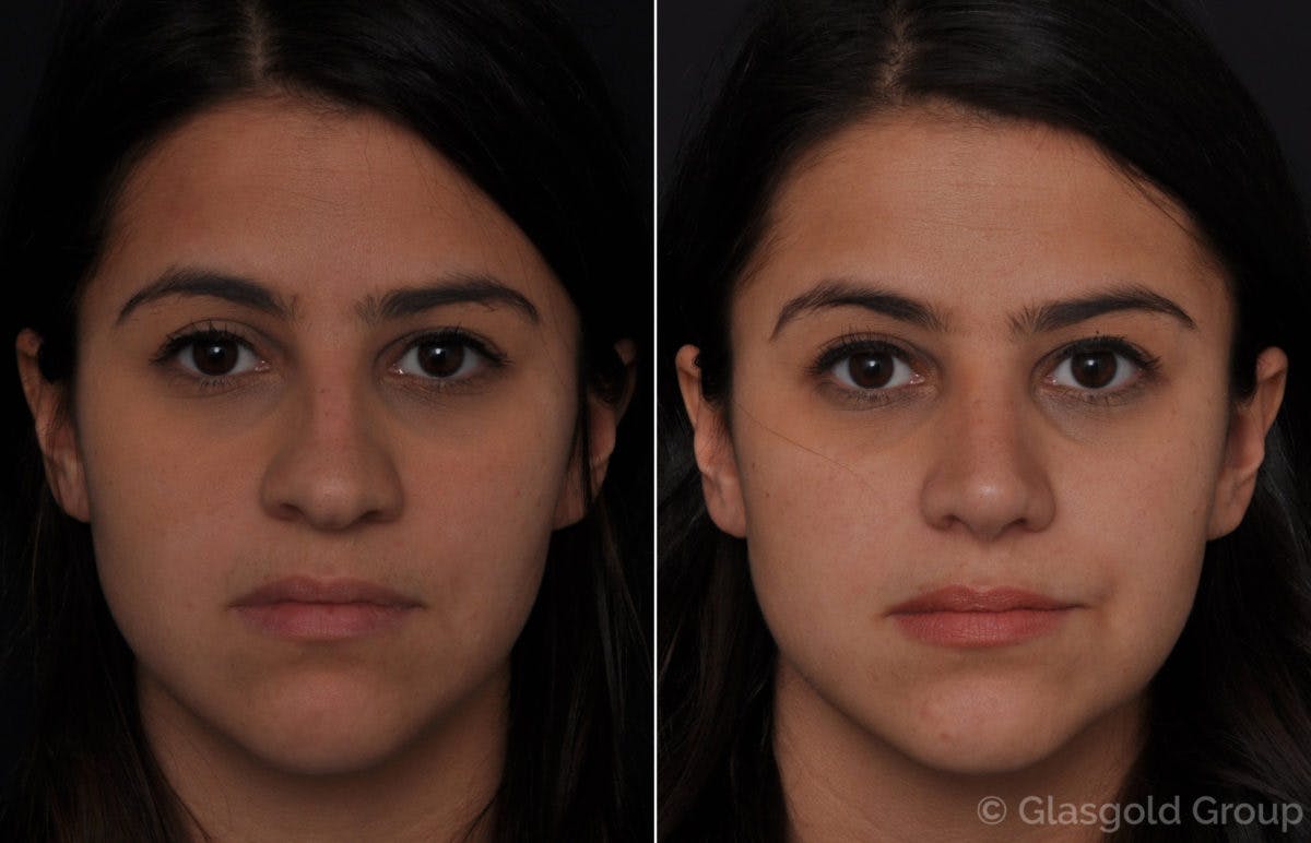 Rhinoplasty Before & After Gallery - Patient 319048 - Image 2