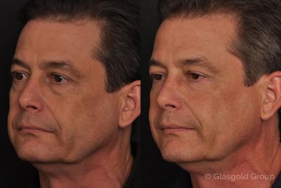 Fat Transfer Before & After Gallery - Patient 324110 - Image 1