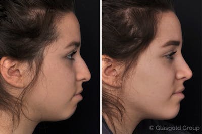 Rhinoplasty Before & After Gallery - Patient 381984 - Image 1