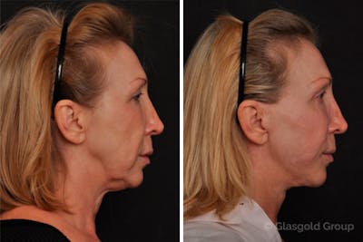 Facelift Before & After Gallery - Patient 131513 - Image 1