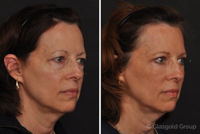 Fat Transfer Before & After Gallery - Patient 312167 - Image 1