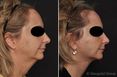 Facelift Before & After Gallery - Patient 956066 - Image 1