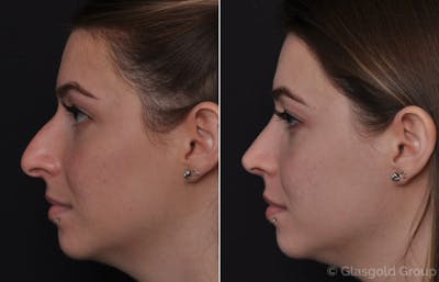 Rhinoplasty Before & After Gallery - Patient 198635 - Image 1