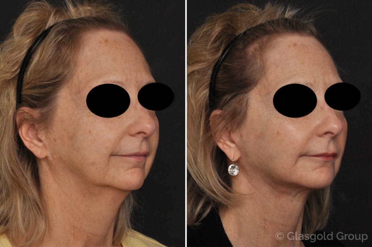 Facelift Before & After Gallery - Patient 956066 - Image 1