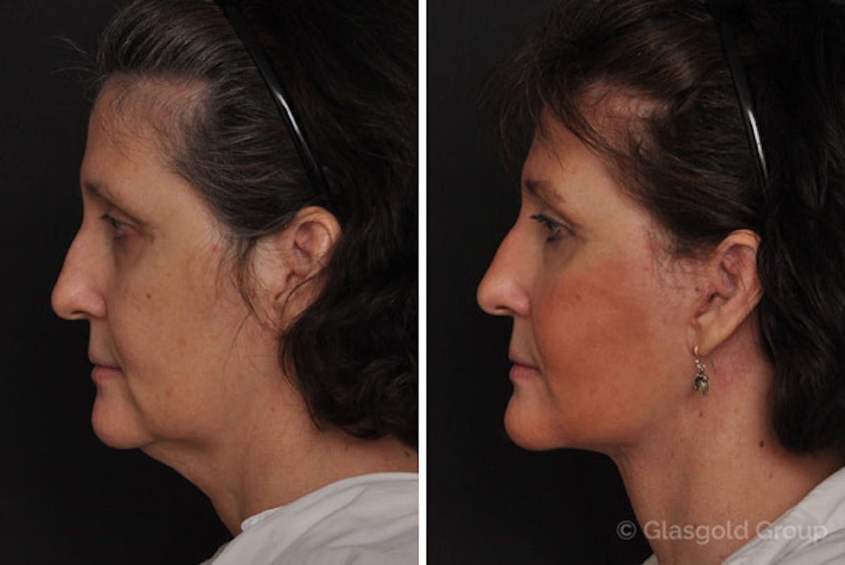 Facelift Before & After Gallery - Patient 400480 - Image 2