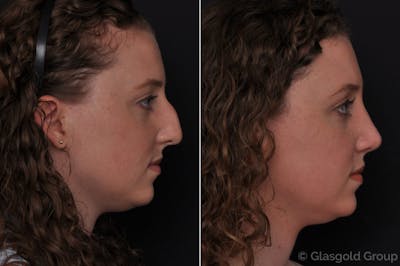 Rhinoplasty Before & After Gallery - Patient 374977 - Image 1