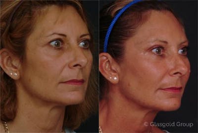 Fat Transfer Before & After Gallery - Patient 216547 - Image 1